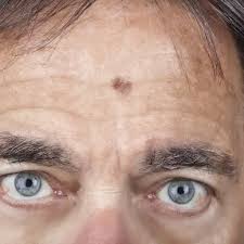 Exposure to ultraviolet light from either sunshine or tanning beds is a known risk factor for most skin cancers and mcc is no exception. Melanoma Treatment Options At Each Stage
