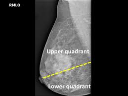 Image result for Mammogram Interpretation