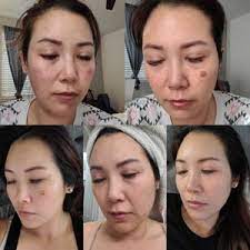 Brazilian laser hair removal results i never liked the look of pubic hair. Broadband Light Bbl Reviews Was It Worth It Realself