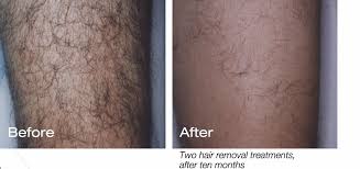 Everyone's body is different, and different biological factors can impact how many sessions you need in order to fully remove your unwanted hair. Does Laser Hair Removal Really Work Laser Hair Removal