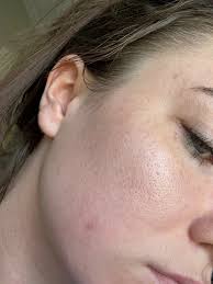 How to fix uneven skin?