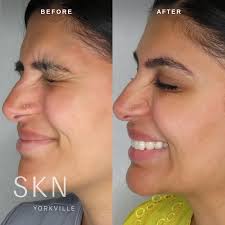 Find that sweet spot and it takes a lot less work to keep it there. Botox For Crow S Feet Lines Or Dysport Xeomin Nuceiva Or Jeuveau Skn