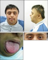 Down syndrome is the most common and readily identifiable chromosomal condition associated with just as in the normal population, there is a wide variation in mental abilities, behavior, and • poor muscle tone; Craniofacial Characteristics In Saudi Down S Syndrome Sciencedirect