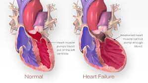 Why your income affects your health insurance premium. Find The Best Burial Insurance With Congestive Heart Failure Here