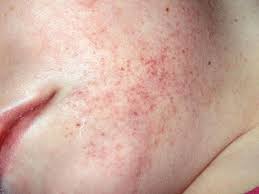 Gliosis is the reactive response of the glial cells in the central nervous system following a trauma or injury to the brain. à¤² à¤¯ à¤• à¤® à¤¯ à¤•à¤¡ à¤‡à¤¶ à¤° à¤•à¤°à¤¤ à¤¤ à¤¹ à¥® à¤²à¤• à¤·à¤£ à¤¦ à¤° à¤²à¤• à¤· à¤•à¤°à¤£ à¤ à¤° à¤¶à¤•à¤¤ à¤œ à¤µà¤˜ à¤£ Marathi News 8 Common Symptoms Of Leukemia Or Blood Cancer That Slowly Eat You Up Latest Health News At Lokmat Com