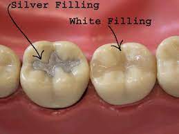 A Composite Tooth Colored Filling Is Used To Repair A Tooth That Is Affected By Decay Cracks Frac Tooth Colored Fillings Affordable Dentist Dental Fillings