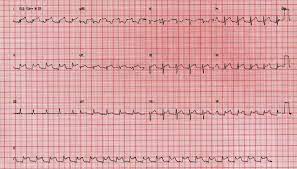 A pericardite aguda é uma inflamação súbita do pericárdio (a estrutura sacular flexível de camada dupla que envolve o coração), muitas vezes dolorosa, . Vale A Pena Usar Colchicina Para Pericardite Aguda Cardiopapers