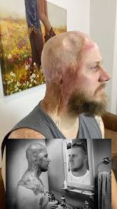 Answering some more questions 🔥🔥⚡️⚡️#fyp #burns #burnsurvivor #trauma  #ptsd #florida #westpalmbeach #southflorida #viral #podcast #miami  #plasticsurgery #reconstruction #healing #recovery #braininjury ...