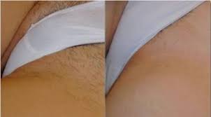 Ingrown hair brazilian laser hair removal before and after photos. Laser Hair Removal Before And After Manchester Clear Medical
