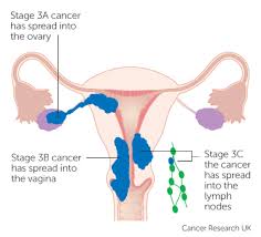 Fortunately, most women with endometrial cancer are diagnosed early and their survival rates are high. Endometrial Cancer Uterine Nzgcf