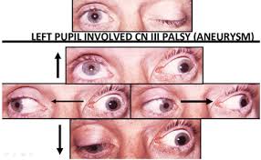 Image result for Pupillary Paralysis