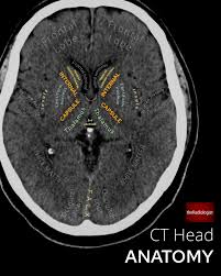 Image result for CT Head