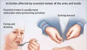 Image result for Essential Tremor