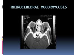 Symptoms and signs include fever, headache, coughing, shortness of breath, abdominal pain, bloody vomit. Mucormycosis