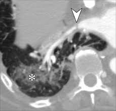 Comprehensive Cross Sectional Imaging Of The Pulmonary Veins Radiographics