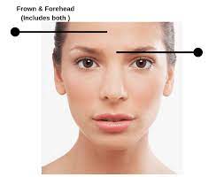 May 31, 2021 · important note that botox doesn't work right away. Botox Pricing Guide Top 4 Areas Of Face Number Of Units Required