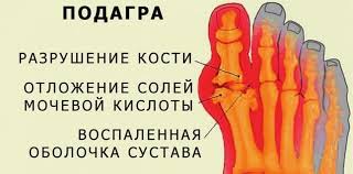 Dieta Pri Podagre Chto Mozhno Est Optimalnoe Menyu Na Kazhdyj Den Osnovnye Principy Pitaniya Pri Bolezni
