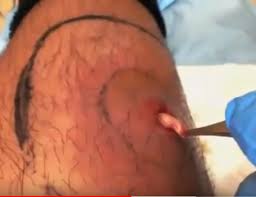 Although staph is a normal bacterium in your skin flora, it can't cause an infection unless it enters a break in the skin. Ingrown Hair Ingrown Hair Staph Infection Symptoms