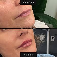 ✨ Subtle, natural, and beautifully refreshed! ✨ Our gorgeous patient wanted  a little more definition and hydration in her lips — and the results with  RHA® Collection 2 are stunning. 💋 RHA