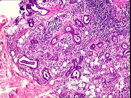 Image result for Sialoadenitis