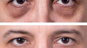 Tratamiento para ojeras en CDMX | +14 años de experiencia