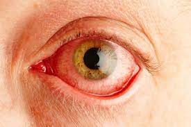 Covid Symptoms Sore Itchy Eyes Could Be Early Coronavirus Warning Sign Experts Say
