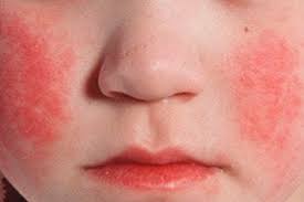 A mild form of scarlet fever. Scarlattina Cause Sintomi Diagnosi Trattamento Con Competenza Per La Salute Su Ilive