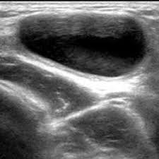 Pain in the groin area can also be caused by wear and tear to the cartilage of the hip joint. Inguinal Sonography Ultrasonography Of The Right Inguinal Area Shows A Download Scientific Diagram
