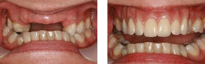 Teeth whitening is not offered on the nhs. Stephen Emms Dentist Dental Implants Doncaster Nhs Dentist Doncaster