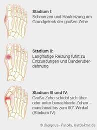 Hallux Valgus Ursachen Und Behandlung Netdoktor