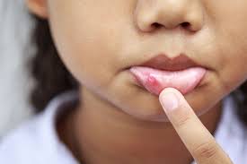 8 Home Remedies To Get Rid Of Canker Sores Quickly