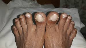 Image result for Clubbing nails feet