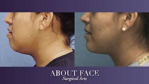 Even though banobagi has been accumulating knowledge and experience in two jaw surgery, we did not settle for the status quo. Jaw Orthognathic Surgery About Face Surgical Arts