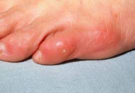 We did not find results for: Corns And Calluses Skin Disorders Merck Manuals Consumer Version