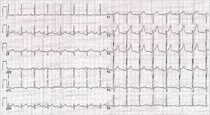 1) hospit si ≥1 facteur majeur (<20% des cas) = fièvre >38, symptomes depuis plusieurs j/sem avec début subaigu, épanchement abondant (>2 cm)/tamponnade, résistance aux ains depuis 1 sem. Pericardite Fichesbook