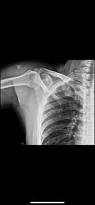 Image result for Shoulder XRay