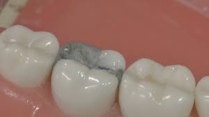 Amalgam is noticeably dark, due to its metallic materials, so it can be obvious in the mouth when you are smiling. How Long Do Dental Fillings Last Dental Health Society