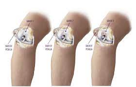 Chondromalacia | Summit Orthopedics