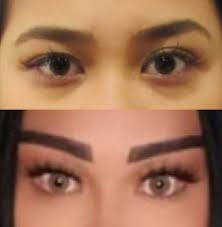 It is sometimes referred to as the manual soft touch method. Cat Eye Or Fox Eye Lift Sydney Dr Zacharia