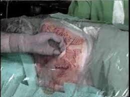 Image result for Intrapleural Anesthesia