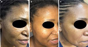 Treatment Outcomes for Dermatosis Papulosa Nigra Using Low‐Intensity  Electrodesiccation Device in African Patients