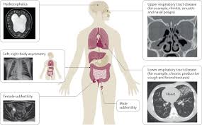 Motile Ciliopathies Nature Reviews Disease Primers