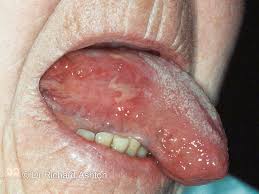 Image result for Pemphigoid