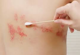Image result for shingles