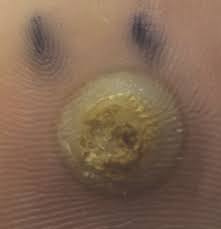 There was a lot of collateral lesson learned: A Stepwise Approach For Treating Plantar Warts In Children Podiatry Today