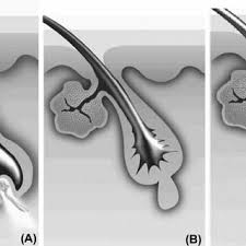 Your guide to trusted bbb ratings, customer reviews and bbb accredited businesses. Pdf Biological And Clinical Aspects In Laser Hair Removal