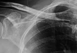 Manifestaciones clínicas y patrones de evolución. Diabetes Insipida Resonancia Magnetica En La Esclerosis Multiple Diabetes Insipida Diagnostico Gpnotebooks