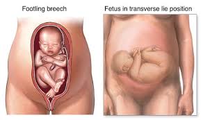 Breached baby pregnancy by pappy2000: Is Baby In A Breech Position How To Tell What To Do