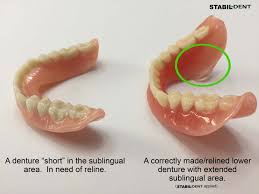 The soft reline procedure is one that applies a soft liner to the inside of your denture for a better fit. Getting A Denture Reline What You Need To Know To Get A Great Reline