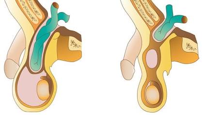 Mecanismo De Descenso De La Hernia Inguinoescrotal Hacia El Compartimento Testicular, Generada Por Ia
